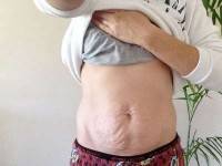 Tummy tucks after pregnancy image