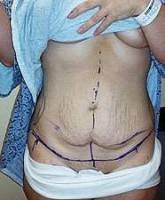 Tummy tucks after pregnancy patients image