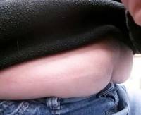 Tummy tucks after pregnancy skin