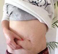 Tummy tucks operation after pregnancy