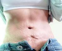 What is the difference between a tummy tuck and a mini tummy tuck image