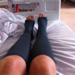 compression stockings surgery