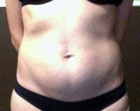 is possible Alternative to tummy tuck surgery