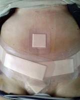A belly button tummy tuck