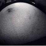 A pregnancy after tummy tuck risks