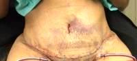 Abdominal swelling after tummy tuck photo
