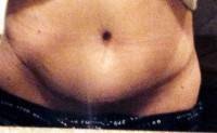 Abdominal swelling after tummy tuck picture