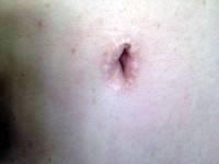Abdominal tummy tuck belly button