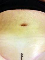 Abdominal tummy tuck belly button after