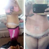 Abdominoplasty after Twins