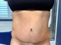 Abdominoplasty after pregnancy before and after