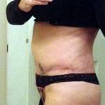 Abdominoplasty after pregnancy picture