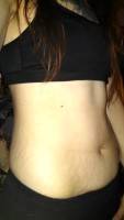Abdominoplasty and pregnancy after photo