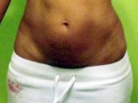 Abdominoplasty before and after weight loss