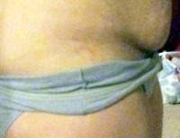 Abdominoplasty muscle tightening picture