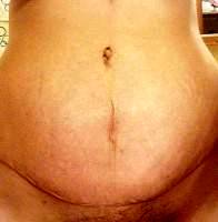 Abdominoplasty recovery time