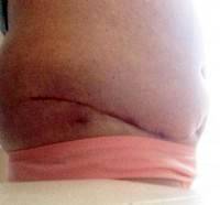 Abdominoplasty scar healing process