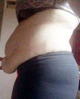 Abdominoplasty surgery picture