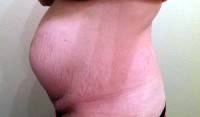 Abdominoplasty weight loss picture before