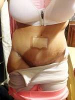 Abdominoplasty without drain tubes