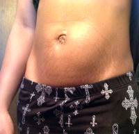 Abdominoplasty without muscle repair image