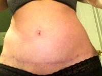 After tummy tuck on thin person