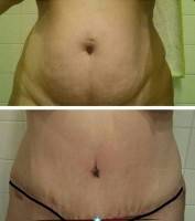 Belly button tummy tuck before and after