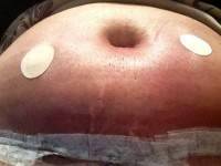 Belly button tummy tuck picture