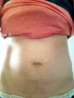 Can you have a tummy tuck after giving birth image