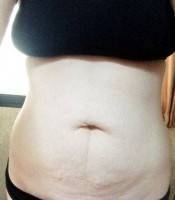 Can you have a tummy tuck after giving birth photo