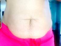 Can you have a tummy tuck after giving birth photos before