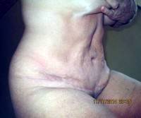 Can you have a tummy tuck after giving birth picture