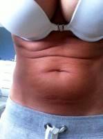 Candidate for Mini Tummy Tuck surgery