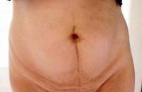 Does a tummy tuck operation get rid of stretch marks
