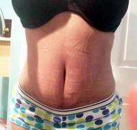 Does a tummy tuck surgery get rid of stretch marks