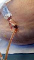 Drains Tummy Tuck surgery