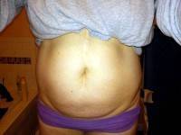 Flat stomach surgery image before
