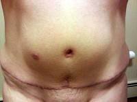 Flat stomach surgery. Scar after tummy tuck