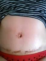 Floating belly button tummy tuck surgery