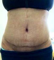 Healed tummy tuck patient's scar