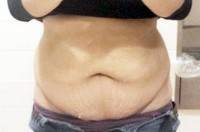 How long is tummy tuck recovery before photo