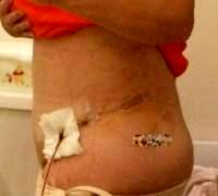 How long is tummy tuck recovery drains photo