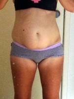 How to repair diastasis recti without surgery picture