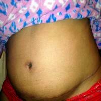 Infected belly button after the tummy tuck