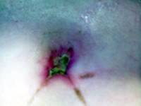 Infected belly button after tummy tuck operationInfected belly button after tummy tuck operation