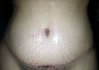Infected belly button after tummy tuck photo
