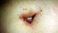 Infected belly button after tummy tuck surgery