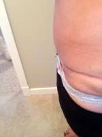 Is a tummy tuck surgery worth it photo