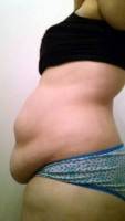 Lateral tension abdominoplasty photo