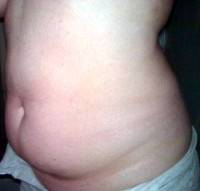 Liposuction and tummy tuck surgery image before